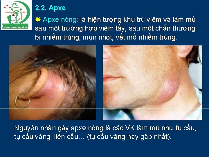 2. 2. Apxe nóng: là hiện tượng khu trú viêm và làm mủ sau