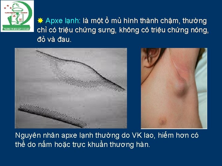  Apxe lạnh: là một ổ mủ hình thành chậm, thường chỉ có triệu