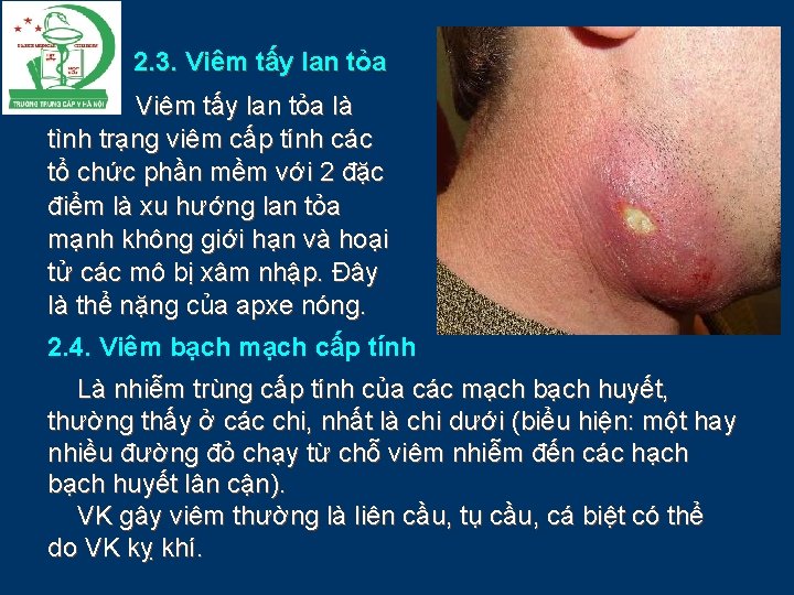 2. 3. Viêm tấy lan tỏa là tình trạng viêm cấp tính các tổ