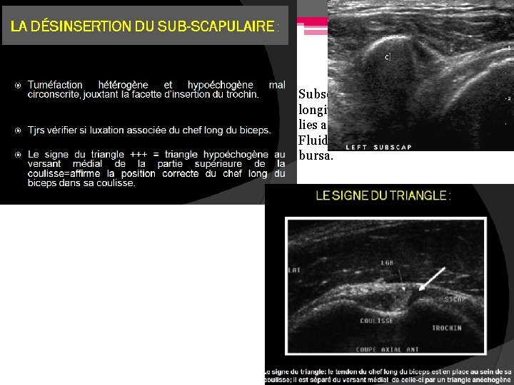 Subscapularis tendon and coracoid pro longitudinal view. The coracoid proces lies anteriorly to the Subscapularis tendon and coracoid pro longitudinal view. The coracoid proces lies anteriorly to the