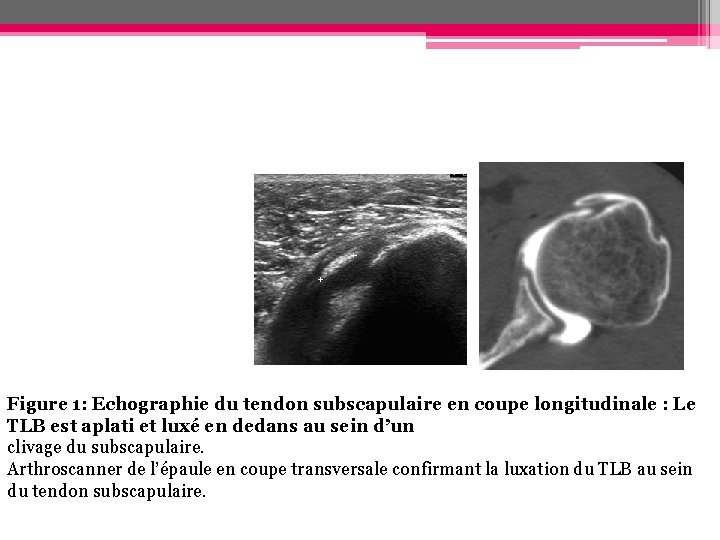 Figure 1: Echographie du tendon subscapulaire en coupe longitudinale : Le TLB est aplati Figure 1: Echographie du tendon subscapulaire en coupe longitudinale : Le TLB est aplati