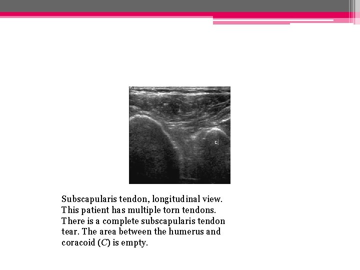 Subscapularis tendon, longitudinal view. This patient has multiple torn tendons. There is a complete Subscapularis tendon, longitudinal view. This patient has multiple torn tendons. There is a complete