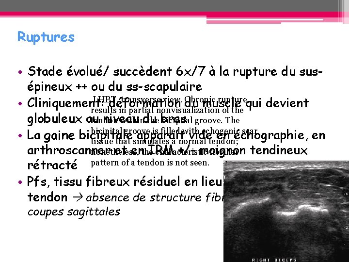 Ruptures • Stade évolué/ succèdent 6 x/7 à la rupture du susépineux ++ ou Ruptures • Stade évolué/ succèdent 6 x/7 à la rupture du susépineux ++ ou