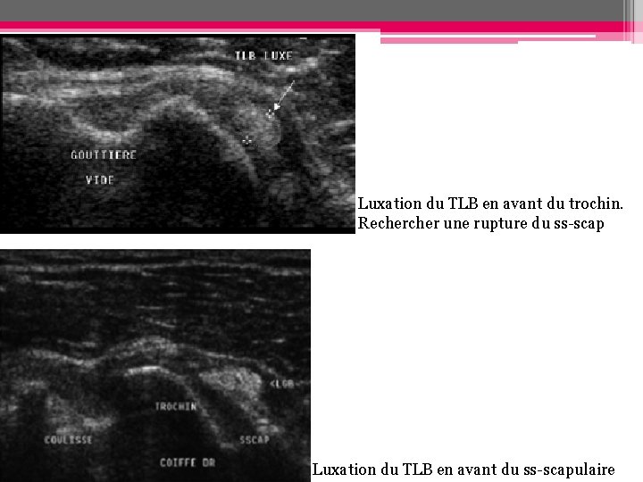 Luxation du TLB en avant du trochin. Recher une rupture du ss-scap Luxation du Luxation du TLB en avant du trochin. Recher une rupture du ss-scap Luxation du