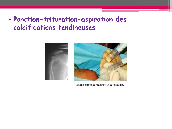 • Ponction-trituration-aspiration des calcifications tendineuses • Ponction-trituration-aspiration des calcifications tendineuses