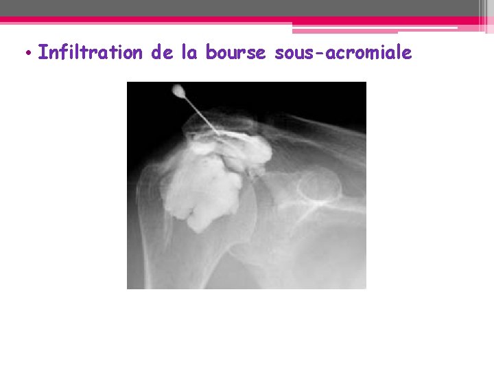 • Infiltration de la bourse sous-acromiale • Infiltration de la bourse sous-acromiale