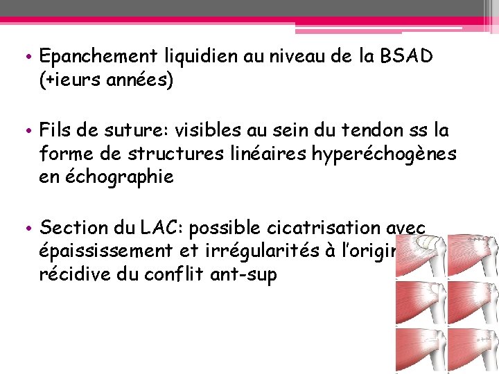 • Epanchement liquidien au niveau de la BSAD (+ieurs années) • Fils de • Epanchement liquidien au niveau de la BSAD (+ieurs années) • Fils de
