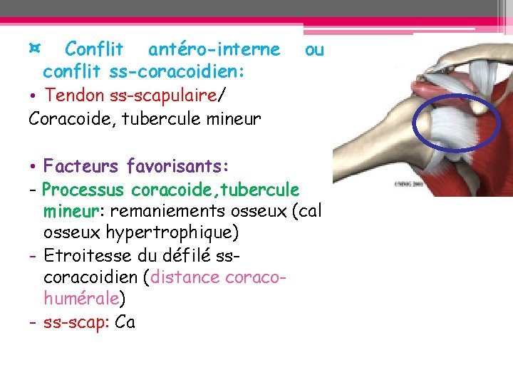 ¤ Conflit antéro-interne conflit ss-coracoidien: • Tendon ss-scapulaire/ Coracoide, tubercule mineur ou • Facteurs ¤ Conflit antéro-interne conflit ss-coracoidien: • Tendon ss-scapulaire/ Coracoide, tubercule mineur ou • Facteurs