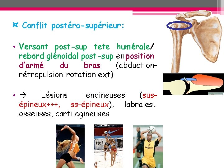 ¤ Conflit postéro-supérieur: • Versant post-sup tete humérale/ rebord glénoidal post-sup en position d’armé ¤ Conflit postéro-supérieur: • Versant post-sup tete humérale/ rebord glénoidal post-sup en position d’armé