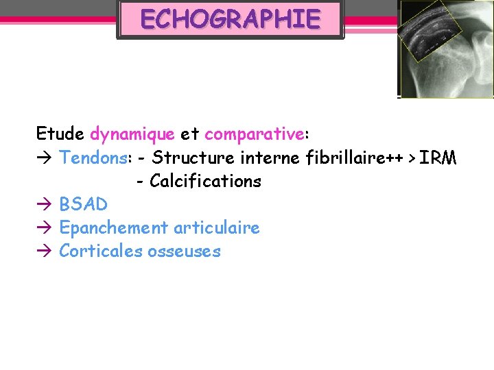 ECHOGRAPHIE Etude dynamique et comparative: Tendons: - Structure interne fibrillaire++ > IRM - Calcifications ECHOGRAPHIE Etude dynamique et comparative: Tendons: - Structure interne fibrillaire++ > IRM - Calcifications