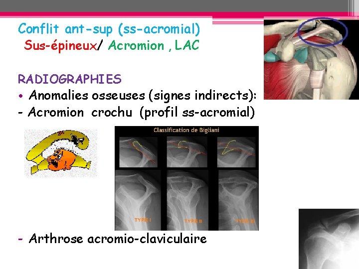 Conflit ant-sup (ss-acromial) Sus-épineux/ Acromion , LAC RADIOGRAPHIES • Anomalies osseuses (signes indirects): - Conflit ant-sup (ss-acromial) Sus-épineux/ Acromion , LAC RADIOGRAPHIES • Anomalies osseuses (signes indirects): -