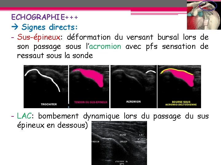 ECHOGRAPHIE+++ Signes directs: - Sus-épineux: déformation du versant bursal lors de son passage sous ECHOGRAPHIE+++ Signes directs: - Sus-épineux: déformation du versant bursal lors de son passage sous