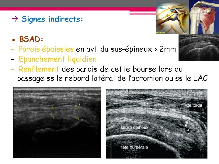 Signes indirects: ▪ - BSAD: Parois épaissies en avt du sus-épineux > 2 Signes indirects: ▪ - BSAD: Parois épaissies en avt du sus-épineux > 2