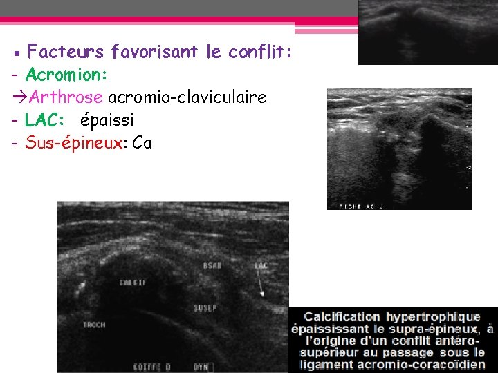 ▪ Facteurs favorisant le conflit: - Acromion: Arthrose acromio-claviculaire - LAC: épaissi - Sus-épineux: ▪ Facteurs favorisant le conflit: - Acromion: Arthrose acromio-claviculaire - LAC: épaissi - Sus-épineux: