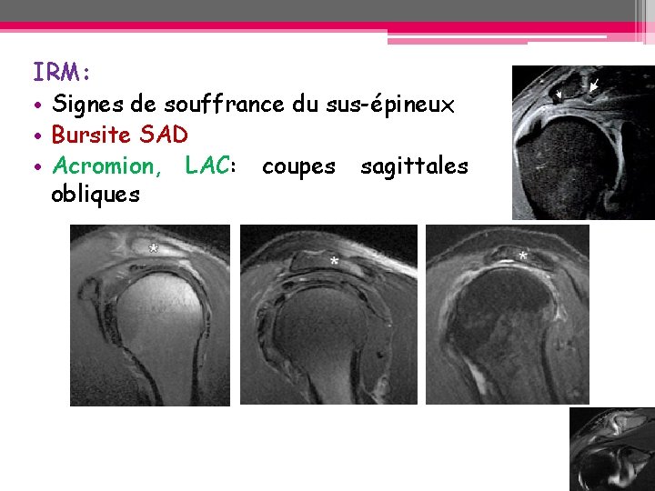 IRM: • Signes de souffrance du sus-épineux • Bursite SAD • Acromion, LAC: coupes IRM: • Signes de souffrance du sus-épineux • Bursite SAD • Acromion, LAC: coupes