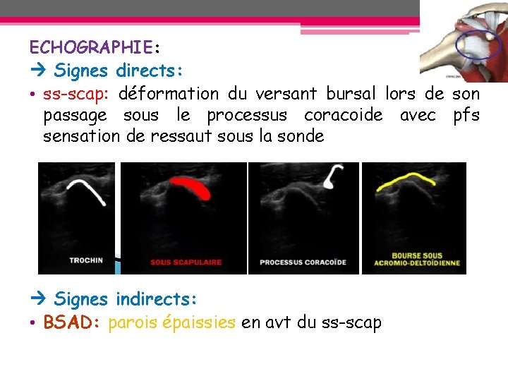 ECHOGRAPHIE: Signes directs: • ss-scap: déformation du versant bursal lors de son passage sous ECHOGRAPHIE: Signes directs: • ss-scap: déformation du versant bursal lors de son passage sous