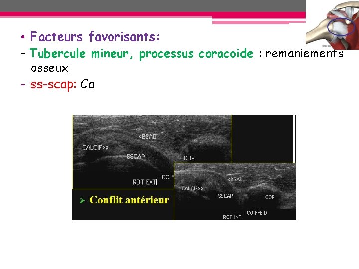 • Facteurs favorisants: - Tubercule mineur, processus coracoide : remaniements osseux - ss-scap: • Facteurs favorisants: - Tubercule mineur, processus coracoide : remaniements osseux - ss-scap: