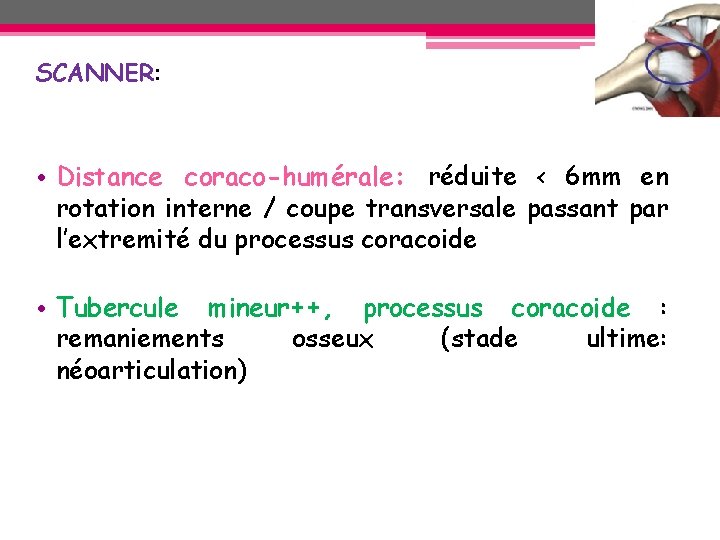 SCANNER: • Distance coraco-humérale: réduite < 6 mm en rotation interne / coupe transversale SCANNER: • Distance coraco-humérale: réduite < 6 mm en rotation interne / coupe transversale