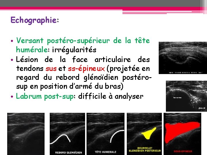 Echographie: • Versant postéro-supérieur de la tête humérale: irrégularités • Lésion de la face Echographie: • Versant postéro-supérieur de la tête humérale: irrégularités • Lésion de la face