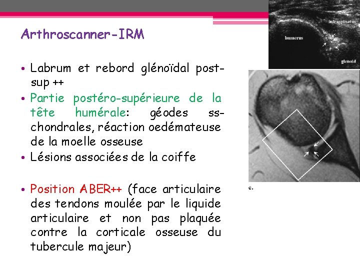 Arthroscanner-IRM • Labrum et rebord glénoïdal postsup ++ • Partie postéro-supérieure de la tête Arthroscanner-IRM • Labrum et rebord glénoïdal postsup ++ • Partie postéro-supérieure de la tête