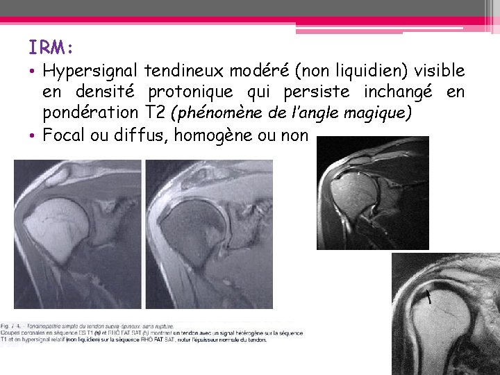IRM: • Hypersignal tendineux modéré (non liquidien) visible en densité protonique qui persiste inchangé IRM: • Hypersignal tendineux modéré (non liquidien) visible en densité protonique qui persiste inchangé
