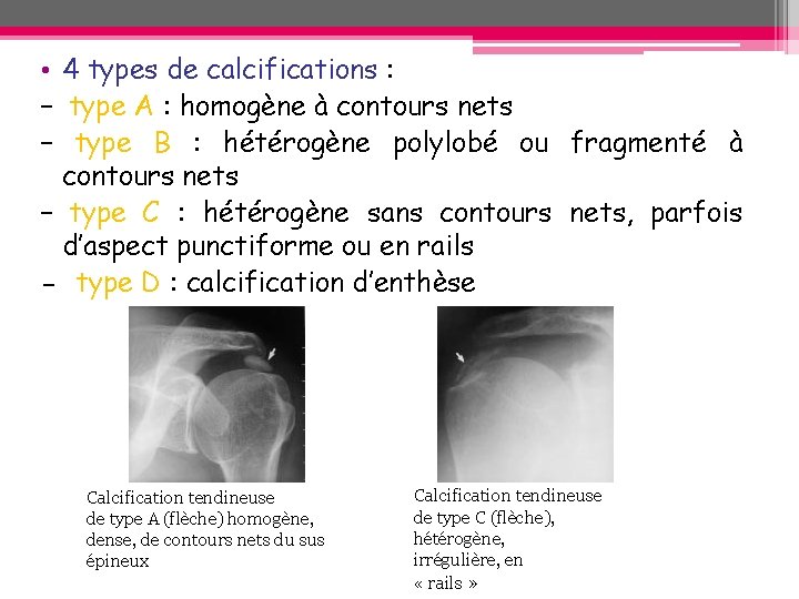 • 4 types de calcifications : – type A : homogène à contours • 4 types de calcifications : – type A : homogène à contours