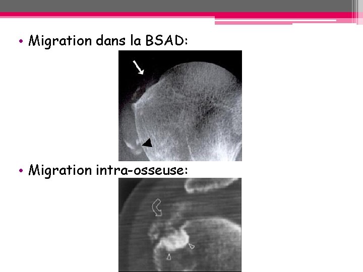 • Migration dans la BSAD: • Migration intra-osseuse: • Migration dans la BSAD: • Migration intra-osseuse: