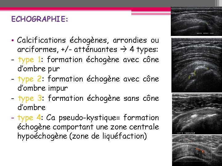 ECHOGRAPHIE: • Calcifications échogènes, arrondies ou arciformes, +/- atténuantes 4 types: - type 1: ECHOGRAPHIE: • Calcifications échogènes, arrondies ou arciformes, +/- atténuantes 4 types: - type 1: