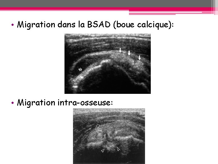• Migration dans la BSAD (boue calcique): • Migration intra-osseuse: • Migration dans la BSAD (boue calcique): • Migration intra-osseuse: