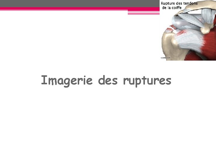 Imagerie des ruptures Imagerie des ruptures