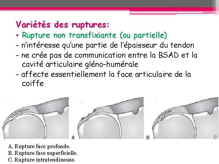Variétés des ruptures: • Rupture non transfixiante (ou partielle) - n’intéresse qu’une partie de Variétés des ruptures: • Rupture non transfixiante (ou partielle) - n’intéresse qu’une partie de