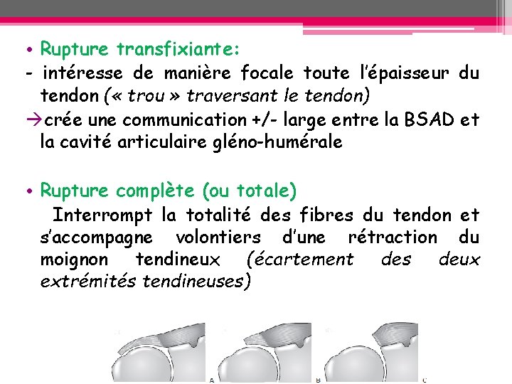 • Rupture transfixiante: - intéresse de manière focale toute l’épaisseur du tendon ( • Rupture transfixiante: - intéresse de manière focale toute l’épaisseur du tendon (