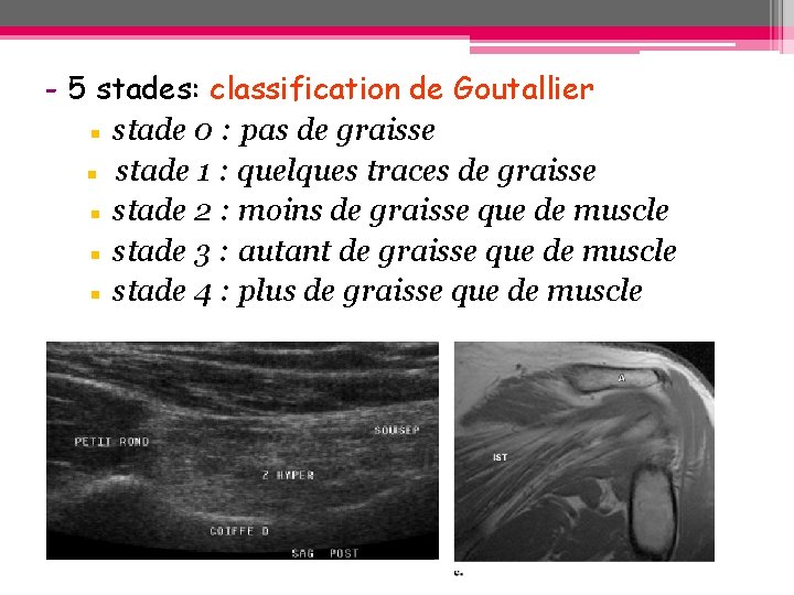 - 5 stades: classification de Goutallier ▪ stade 0 : pas de graisse ▪ - 5 stades: classification de Goutallier ▪ stade 0 : pas de graisse ▪
