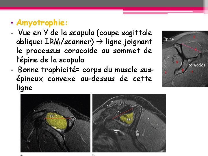 • Amyotrophie: - Vue en Y de la scapula (coupe sagittale oblique: IRM/scanner) • Amyotrophie: - Vue en Y de la scapula (coupe sagittale oblique: IRM/scanner)