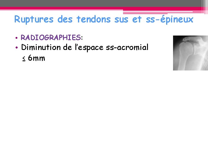 Ruptures des tendons sus et ss-épineux • RADIOGRAPHIES: • Diminution de l’espace ss-acromial ≤ Ruptures des tendons sus et ss-épineux • RADIOGRAPHIES: • Diminution de l’espace ss-acromial ≤