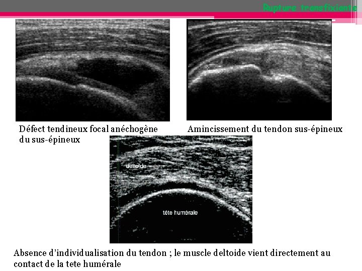 Rupture transfixiante Défect tendineux focal anéchogène du sus-épineux Amincissement du tendon sus-épineux Absence d’individualisation Rupture transfixiante Défect tendineux focal anéchogène du sus-épineux Amincissement du tendon sus-épineux Absence d’individualisation