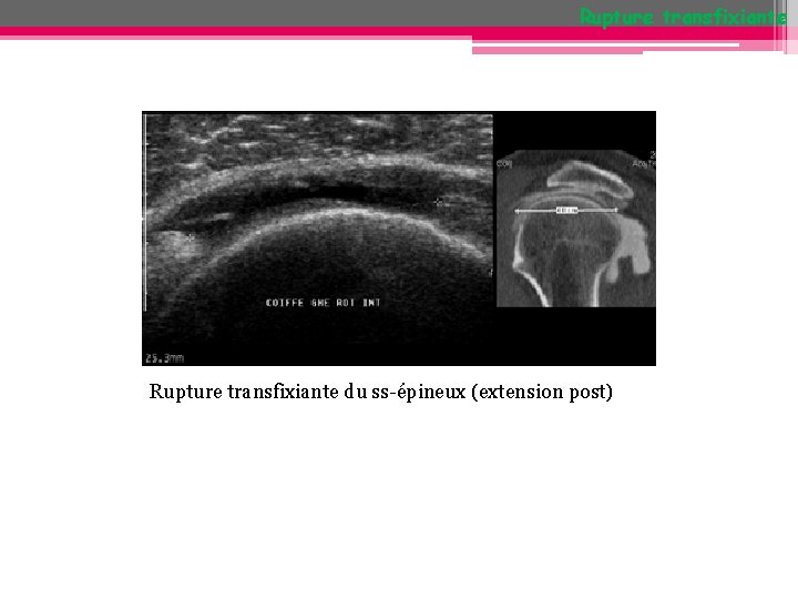 Rupture transfixiante du ss-épineux (extension post) Rupture transfixiante du ss-épineux (extension post)