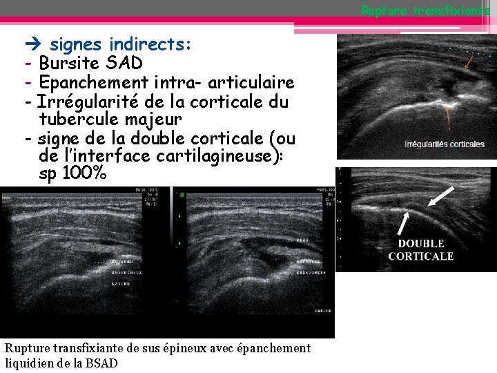 Rupture transfixiante signes indirects: - Bursite SAD - Epanchement intra- articulaire - Irrégularité de Rupture transfixiante signes indirects: - Bursite SAD - Epanchement intra- articulaire - Irrégularité de