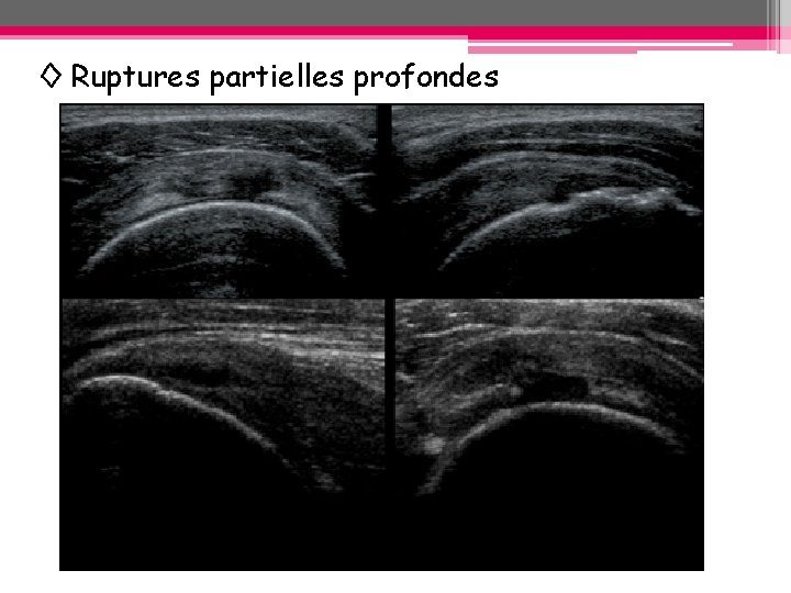 ◊ Ruptures partielles profondes ◊ Ruptures partielles profondes