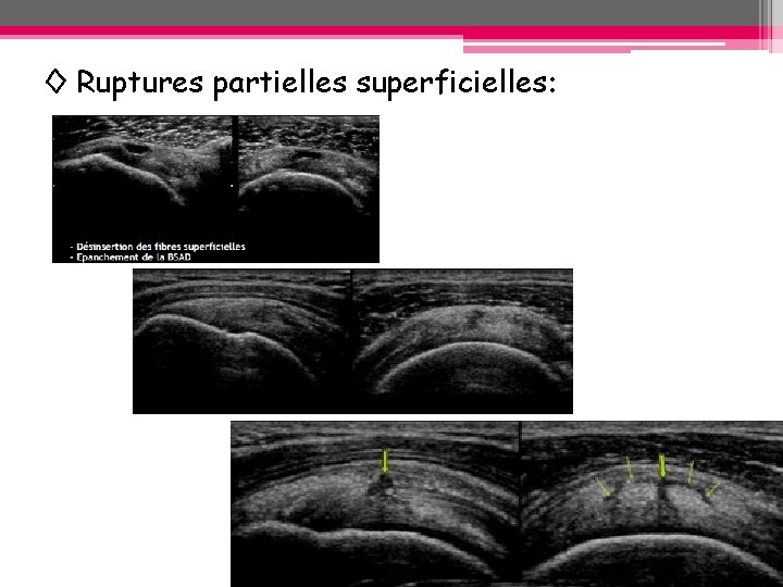 ◊ Ruptures partielles superficielles: ◊ Ruptures partielles superficielles: