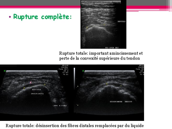 • Rupture complète: Rupture totale: important amincissement et perte de la convexité supérieure • Rupture complète: Rupture totale: important amincissement et perte de la convexité supérieure