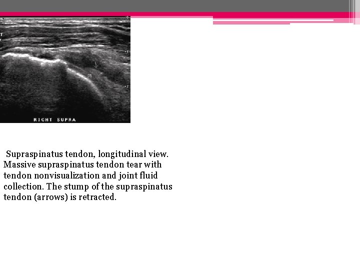 Supraspinatus tendon, longitudinal view. Massive supraspinatus tendon tear with tendon nonvisualization and joint fluid Supraspinatus tendon, longitudinal view. Massive supraspinatus tendon tear with tendon nonvisualization and joint fluid