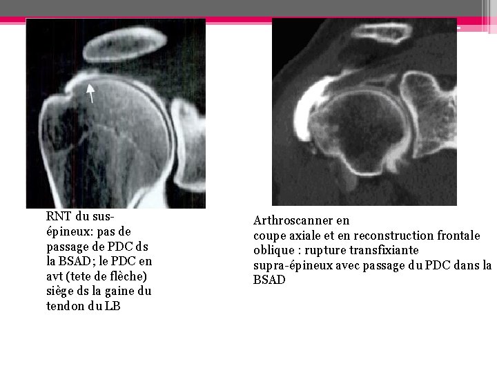 RNT du susépineux: pas de passage de PDC ds la BSAD; le PDC en RNT du susépineux: pas de passage de PDC ds la BSAD; le PDC en