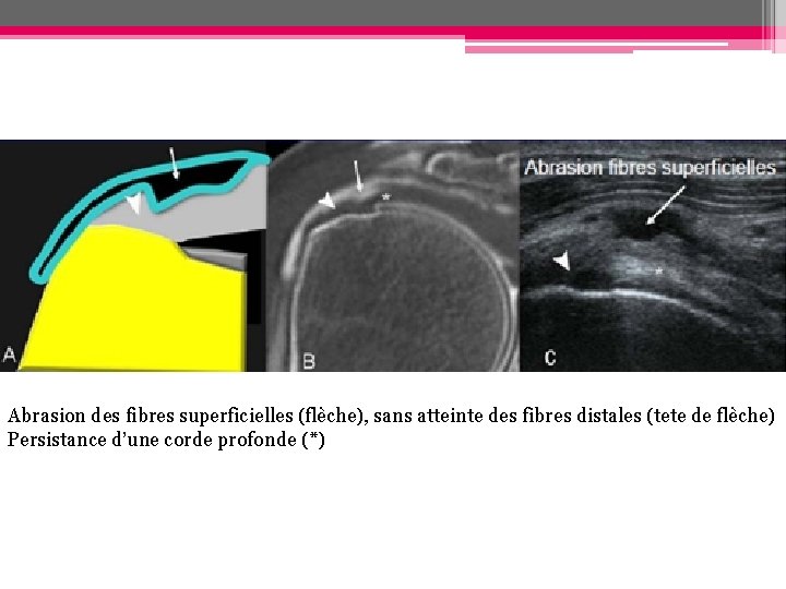 Abrasion des fibres superficielles (flèche), sans atteinte des fibres distales (tete de flèche) Persistance Abrasion des fibres superficielles (flèche), sans atteinte des fibres distales (tete de flèche) Persistance