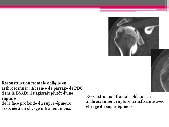 Reconstruction frontale oblique en arthroscanner : Absence de passage de PDC dans la BSAD; Reconstruction frontale oblique en arthroscanner : Absence de passage de PDC dans la BSAD;