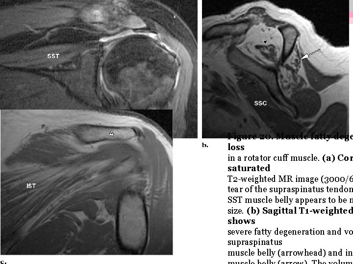 Figure 20. Muscle fatty dege loss in a rotator cuff muscle. (a) Cor saturated Figure 20. Muscle fatty dege loss in a rotator cuff muscle. (a) Cor saturated
