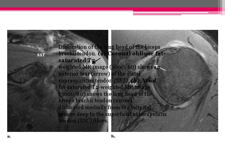 Dislocation of the long head of the biceps brachii tendon. (a) Coronal oblique fatsaturated Dislocation of the long head of the biceps brachii tendon. (a) Coronal oblique fatsaturated