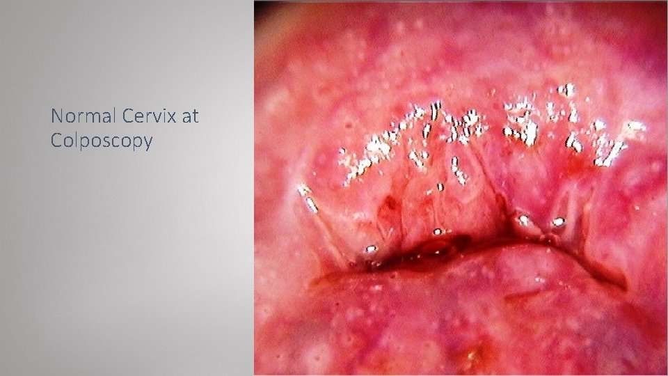 Normal Cervix at Colposcopy 