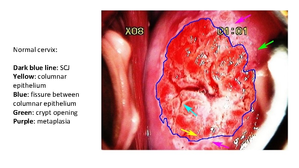 Normal cervix: Dark blue line: SCJ Yellow: columnar epithelium Blue: fissure between columnar epithelium