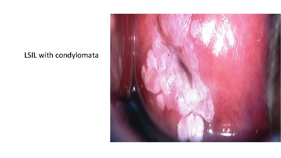 LSIL with condylomata 
